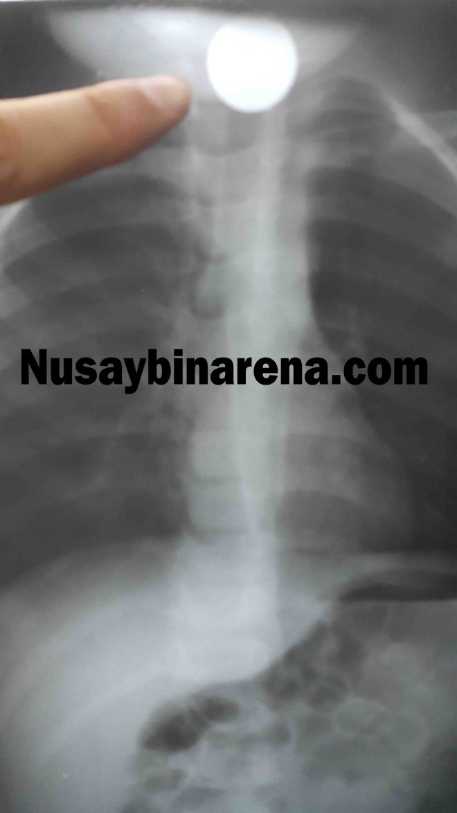 Nusaybin`de Para Yutan Çocuk Hastanelik Oldu